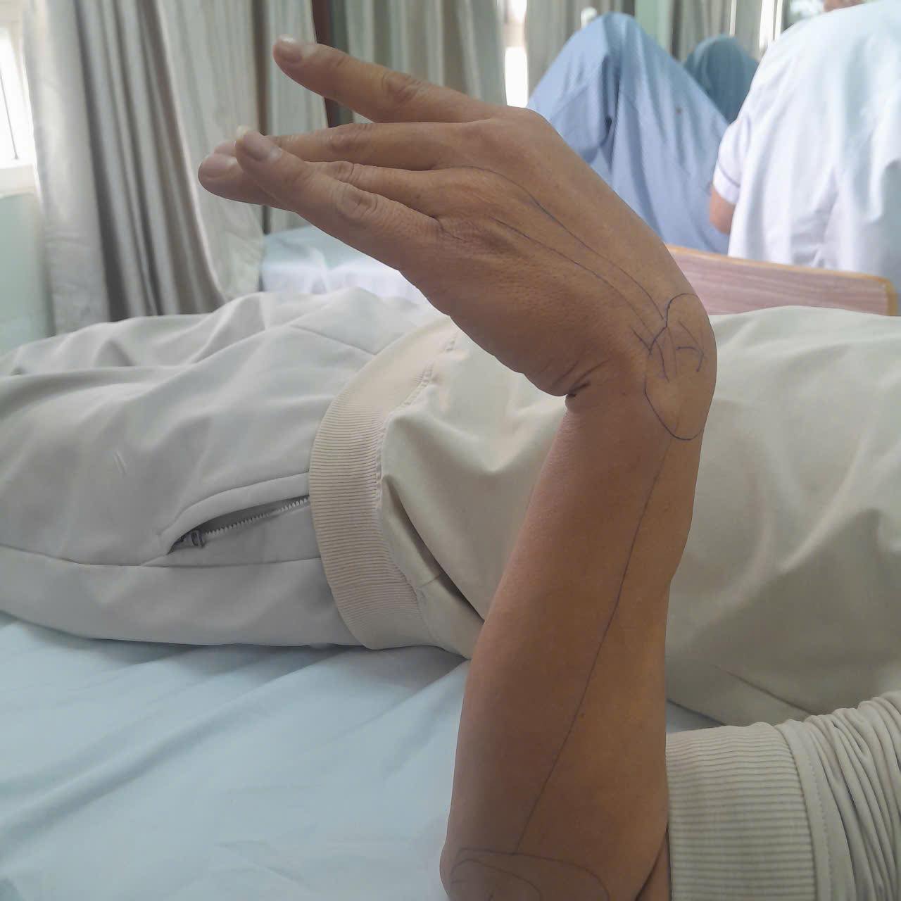 37岁男子枕手打盹导致桡神经麻痹| 越南中文社｜越南新闻与政策信息中文平台