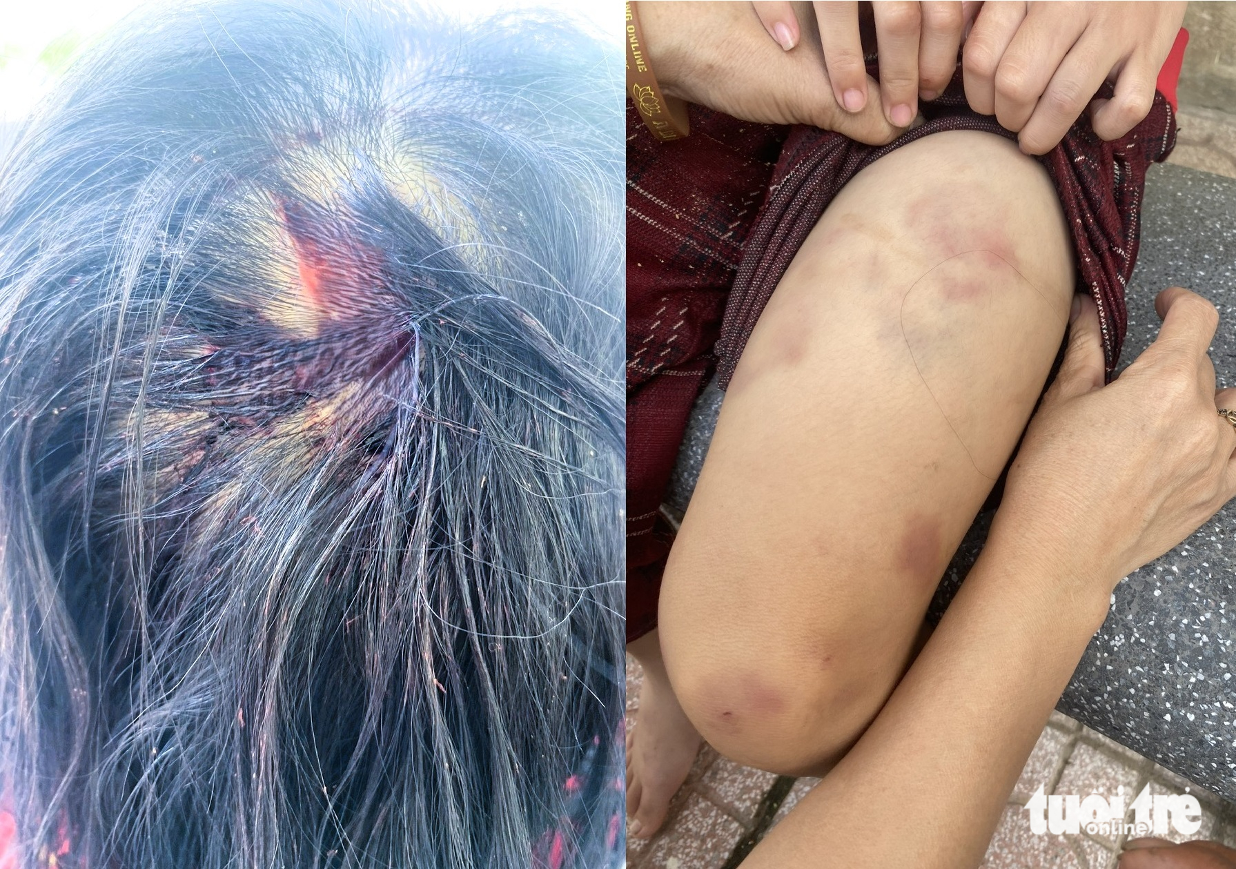 起诉继父用锤子殴打妻子前夫所生孩子的案件